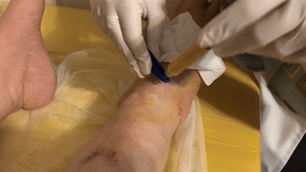 تزریق به مچ پا