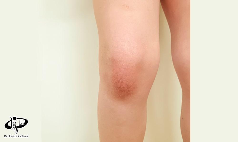 عوارض احتمالی تزریق سلولهای بنیادی با پیارپی به زانو