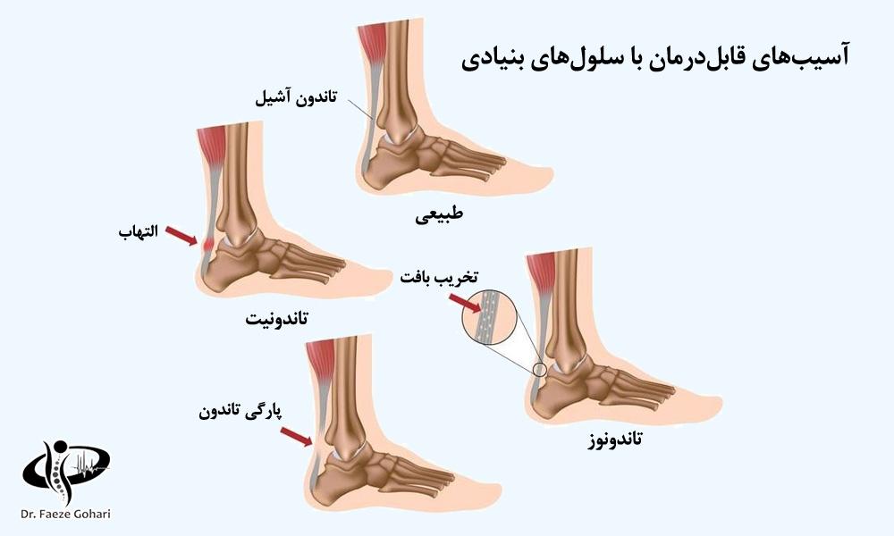 آسیبهای قابلدرمان با سلولهای بنیادی