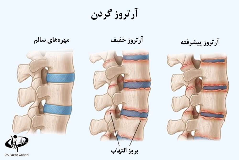 آرتروز گردن