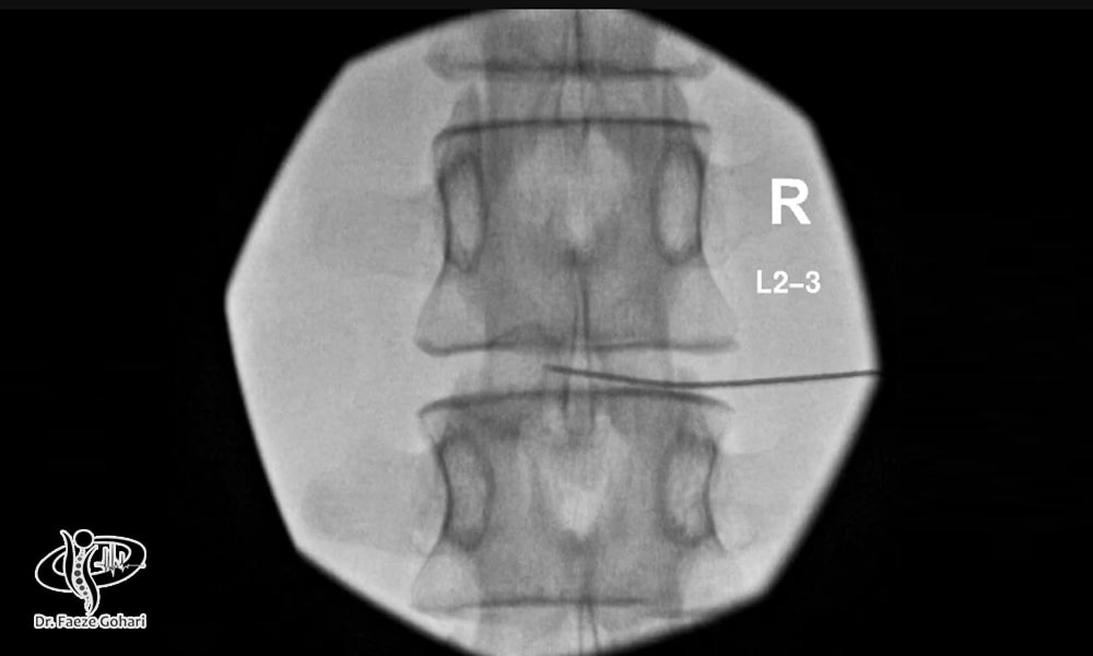 سلول‌درمانی آرتروز کمر 
