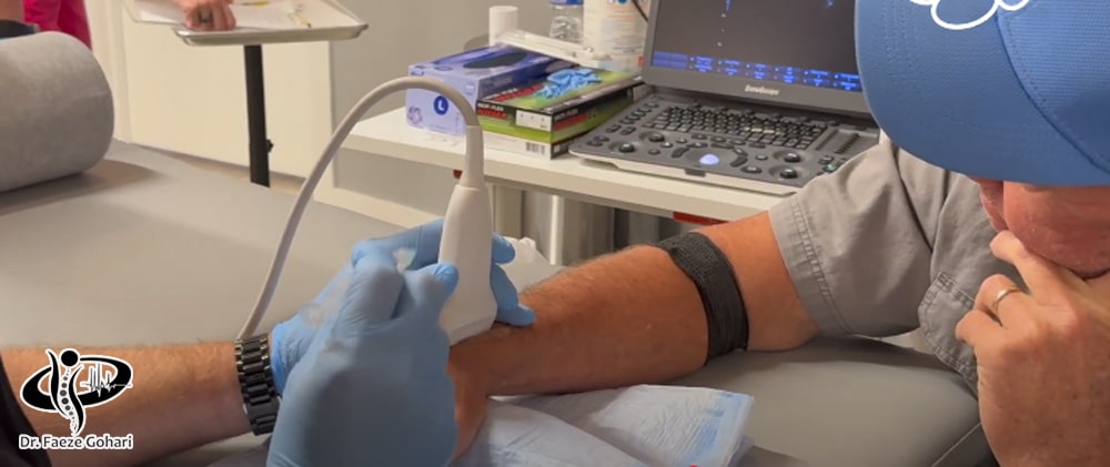 نحوه تزریق سلولهای بنیادی به رباط مچ دست