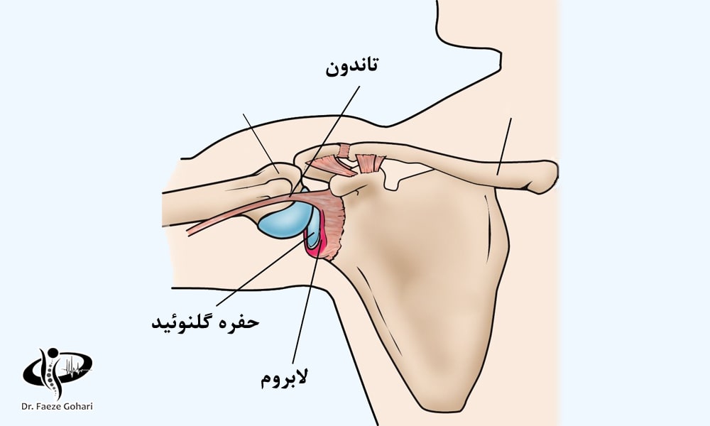 درمان غیرجراحی پارگی لابروم شانه با سلولهای بنیادی و PRP