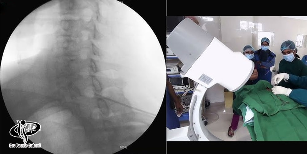 پی‌آرپی (PRP)