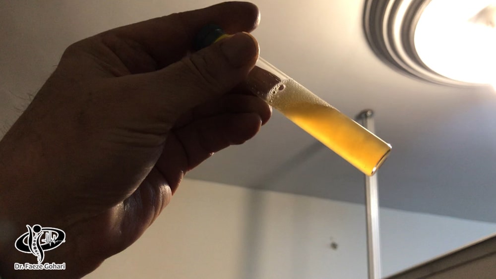 پلاسمای غنی از پلاکت