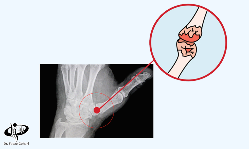 درمان امیدوارکننده آرتروز شست دست