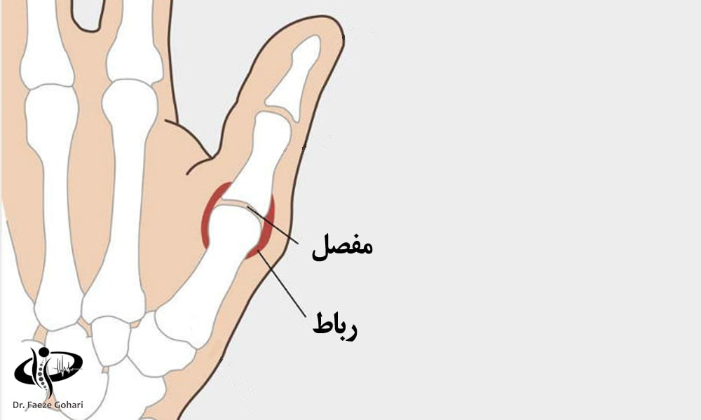 درمان تخصصی آسیب‌های متعدد شست دست