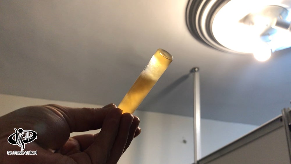 سلولهای بنیادی و PRP (پلاسمای غنی از پلاکت)