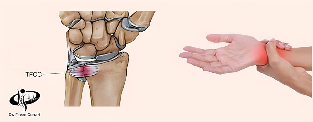کمپلکس فیبروکارتیلاژ مثلثی 