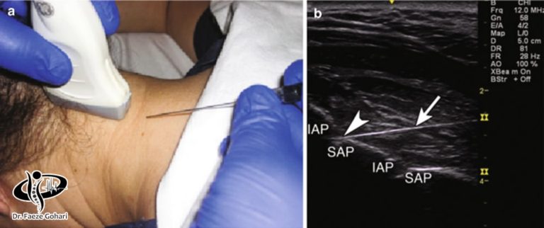 درمان آرتروز گردن با تزریق سلول های بنیادی و پی ار پی
