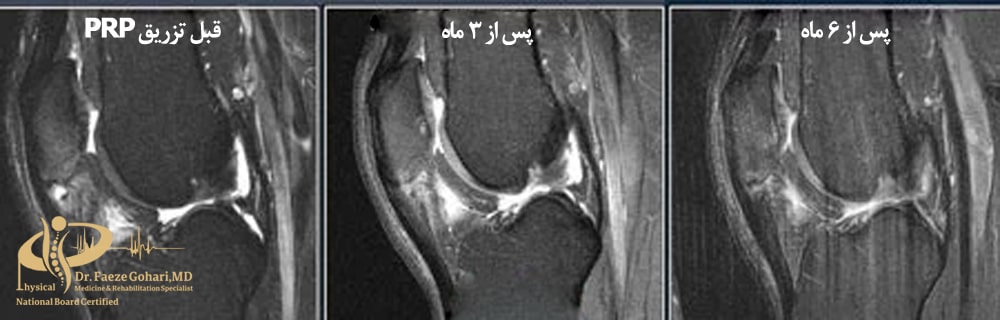 قبل تزریق PRP