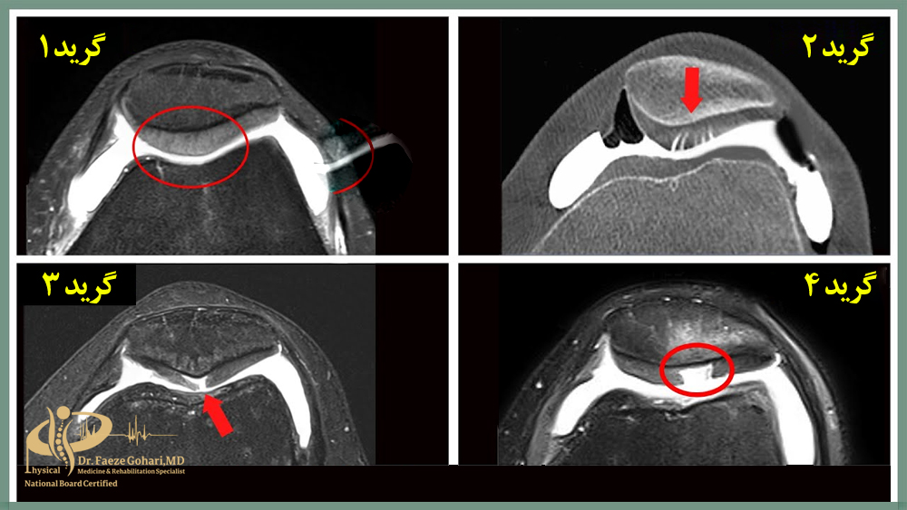 کندرومالاسی کشکک