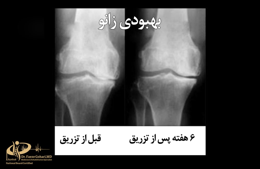 مقایسه پی ار پی زانو با سایر روشهای درمانی