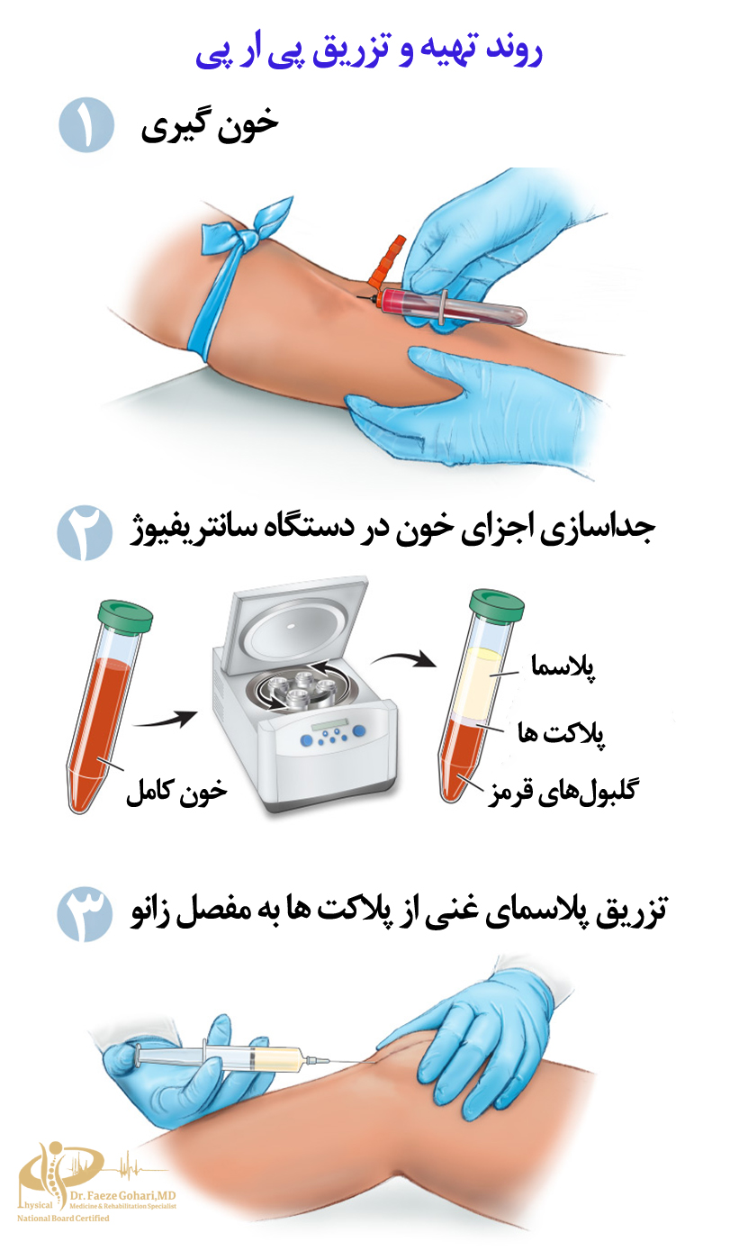 روند تهیه پی آر پی