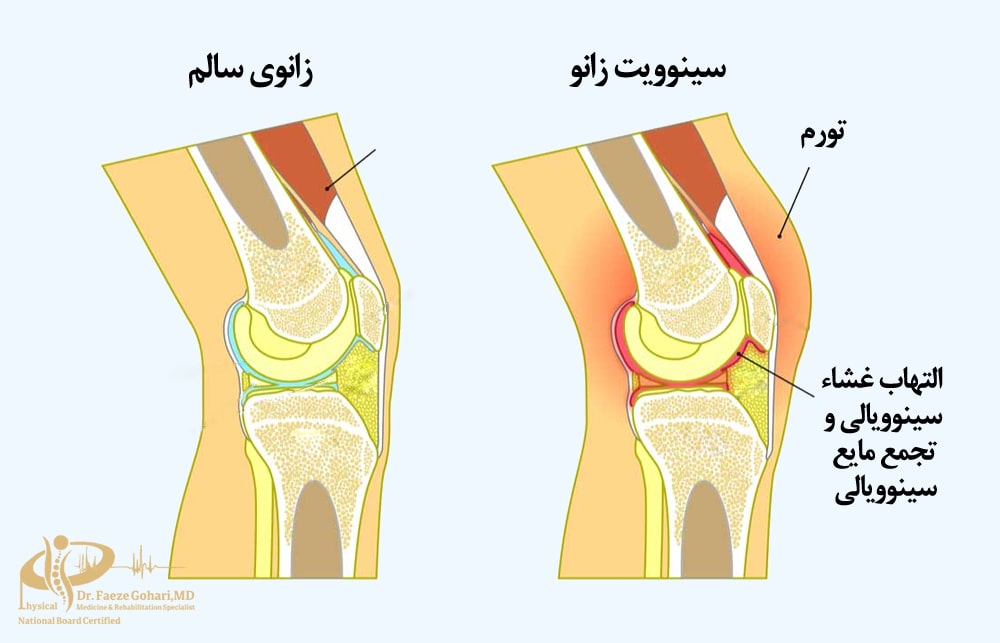 التهاب سینوویال یا بورسیت زانو