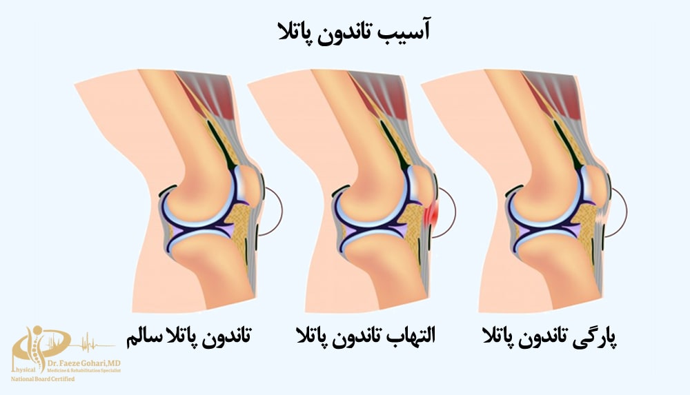آسیبهای تاندون