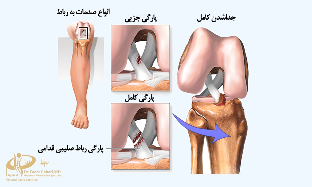 انواع صدمات به رباط