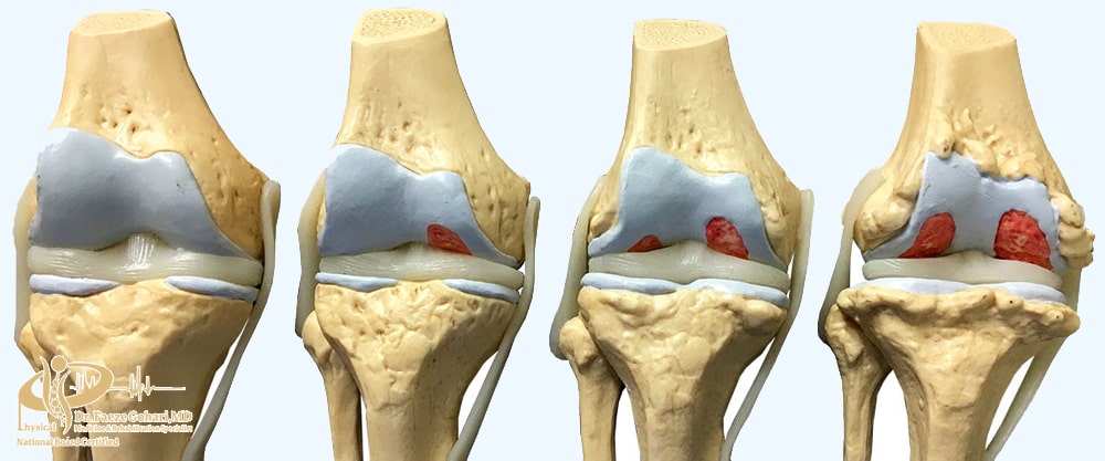 آرتروز زانو