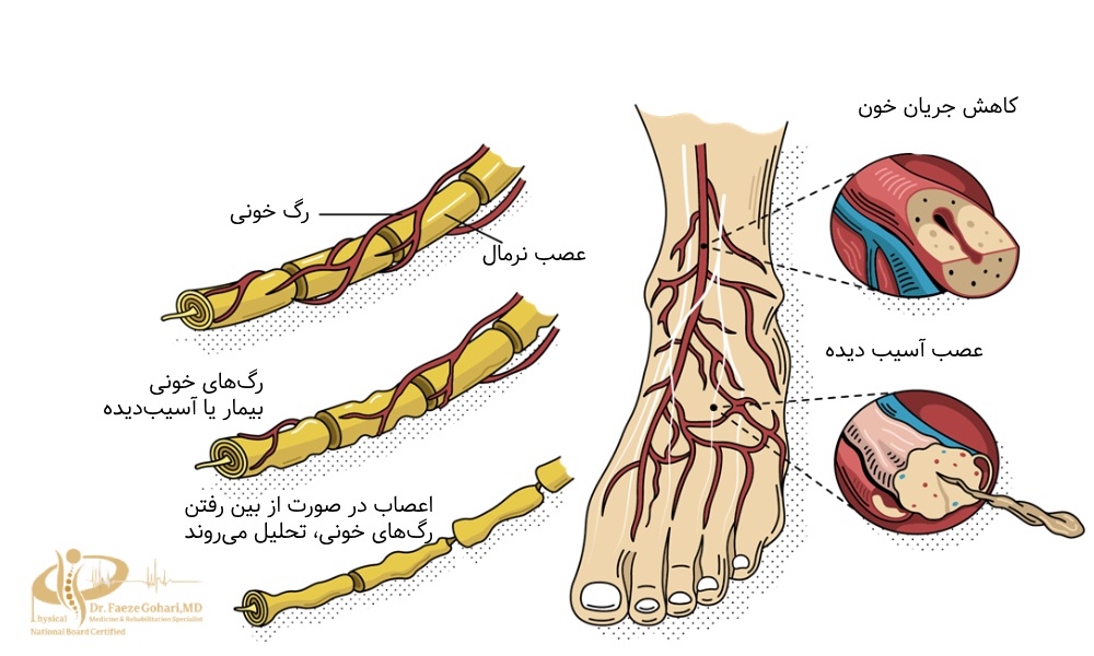 نوروپاتی محیطی