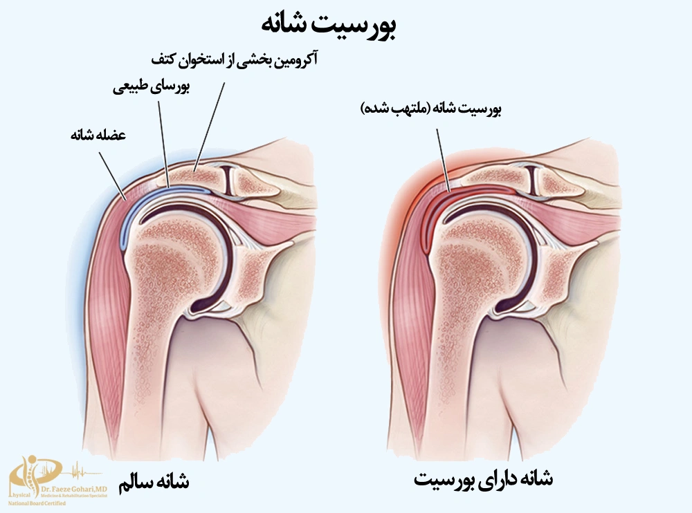 بورسیت زیر شانه و گیرافتادگی تاندونها
