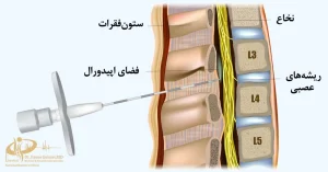 تزریق اپیدورال