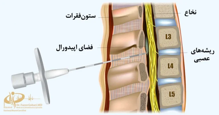 تزریق اپیدورال