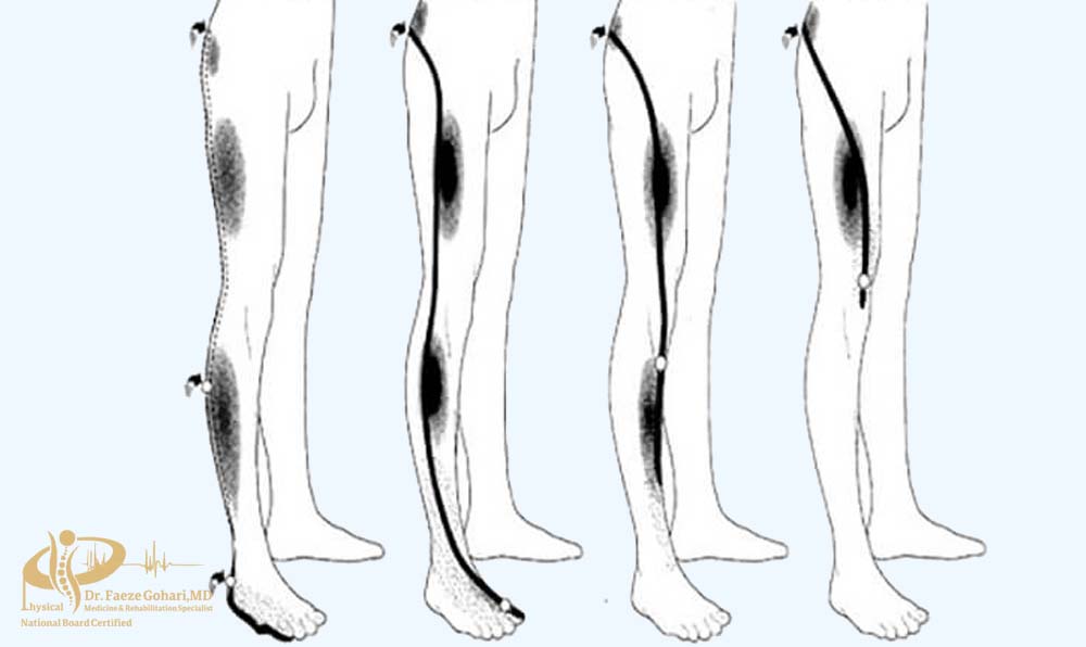 درد سیاتیک کاذب یا واقعی