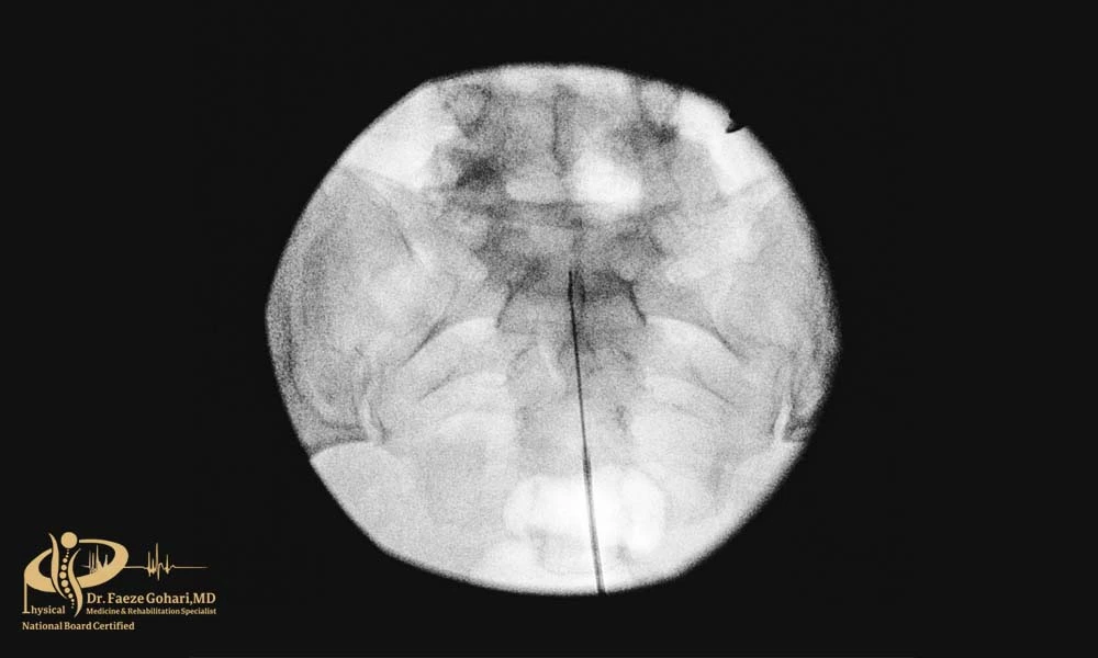 تصویر فلورسکوپ کاتتر 
