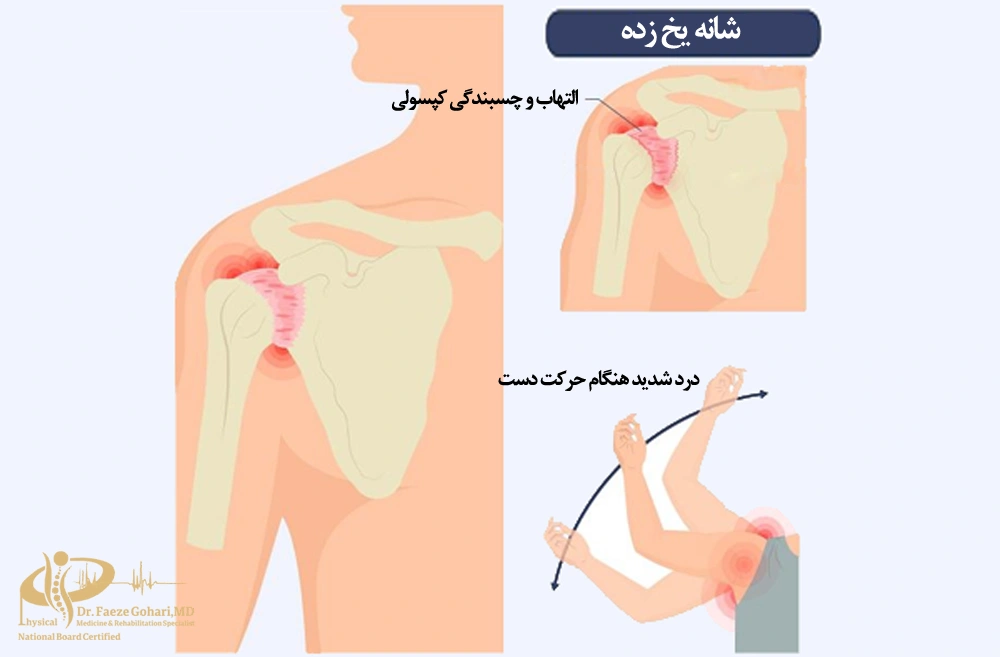 شانه یخ زده