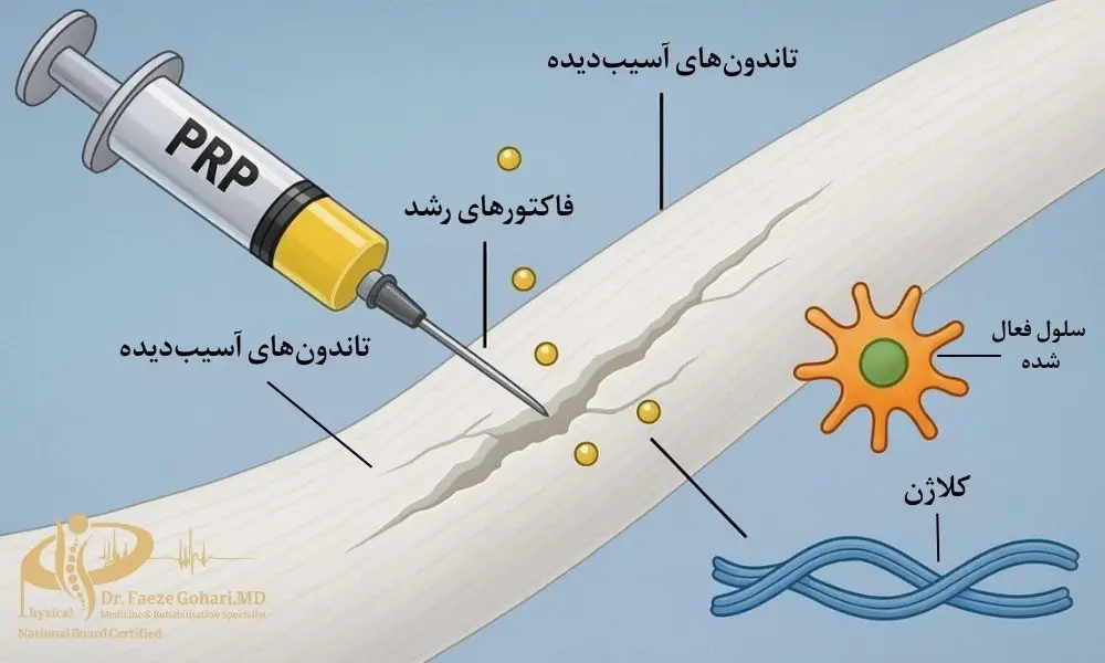 تاندون آسیبدیده