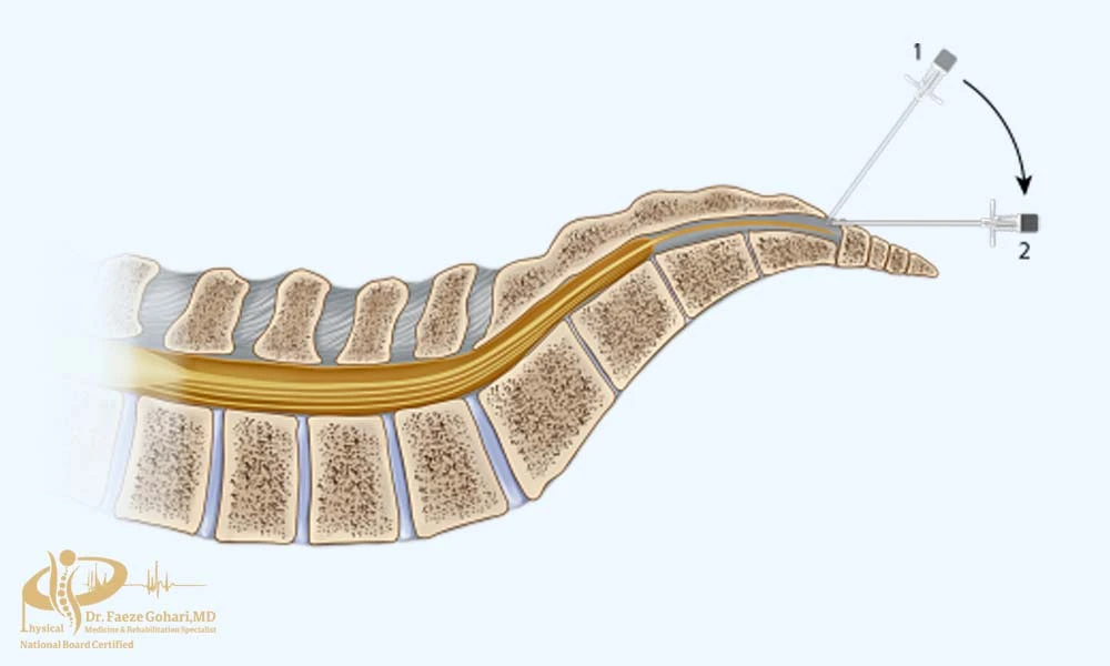 محل ورود سوزن و کاتتر
