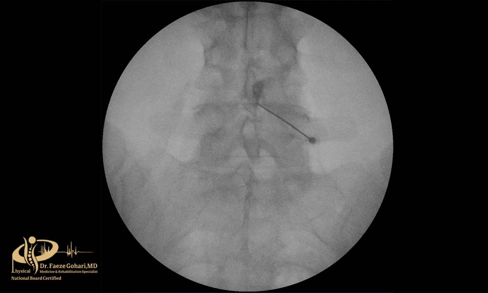 محل ورود سوزن در تزریق اپیدورال 