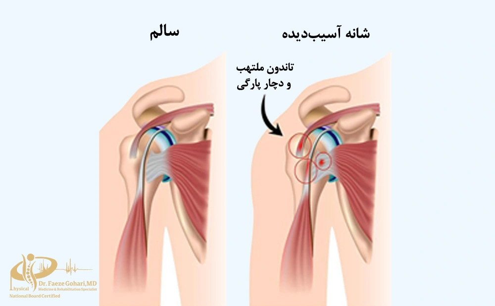 PRP برای درد شانه