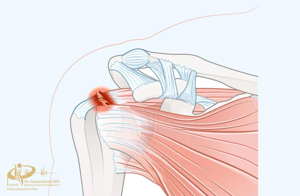 آسیبها و تاندونهای روتاتور کاف