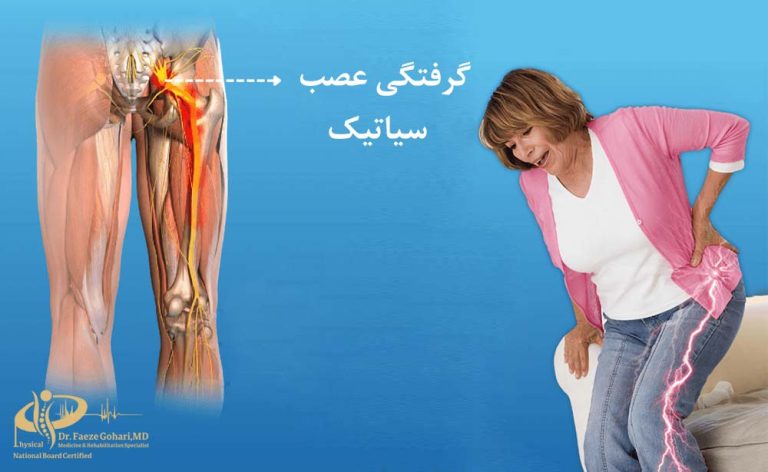 گرفتگی عصب سیاتیک