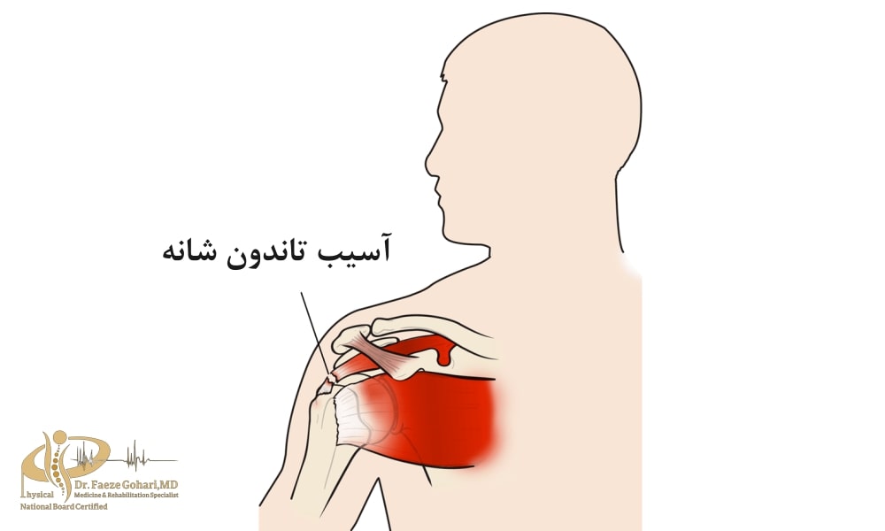 آسیب تاندون شانه