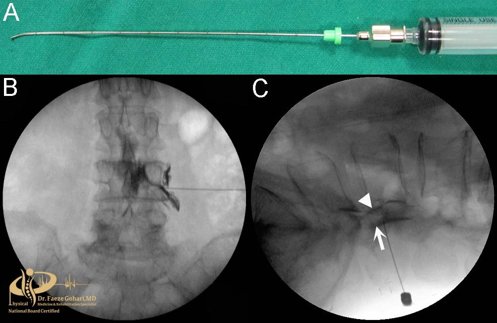 سوزن تزریق اپیدورال ترانس‌فورامینال