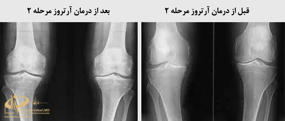 درمان آرتروز
