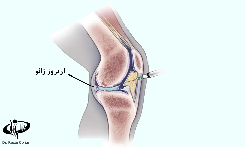 تزریق هیالورونیک اسید