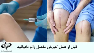 تعویض مفصل زانو