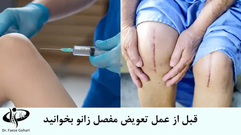 تعویض مفصل زانو