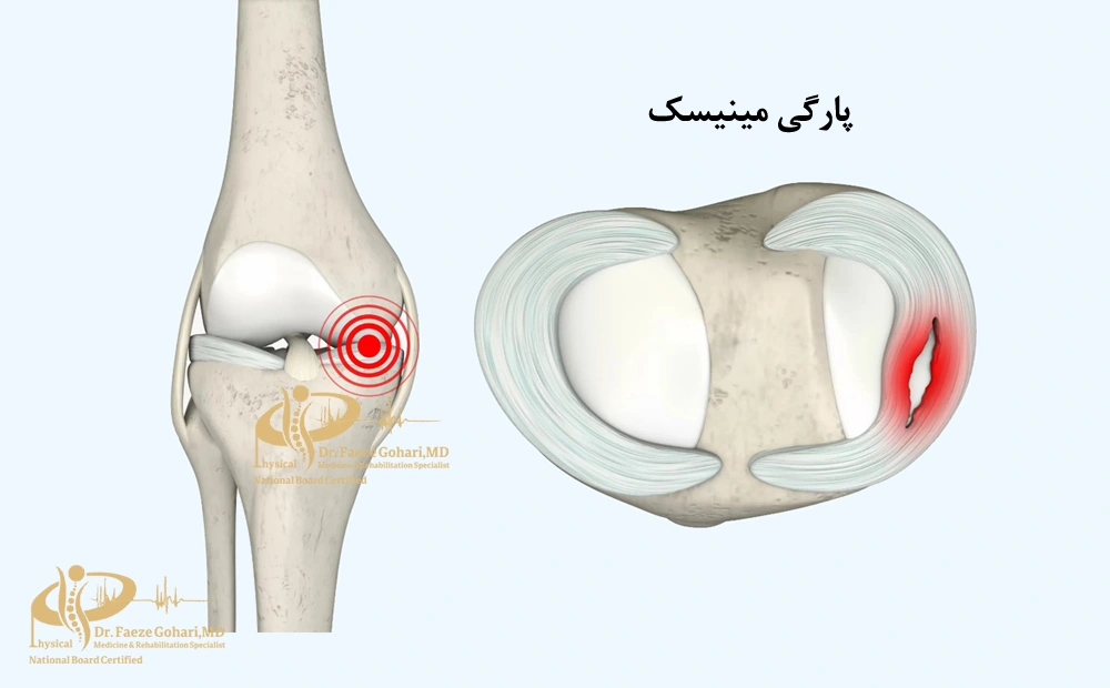 پارگی مینیسک