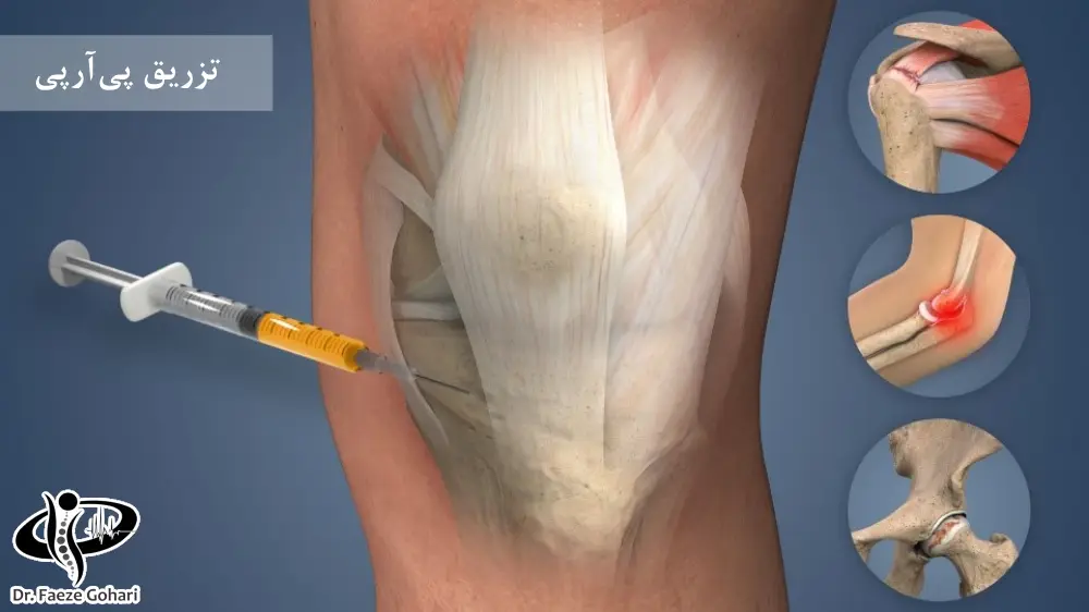 اوزون تراپی