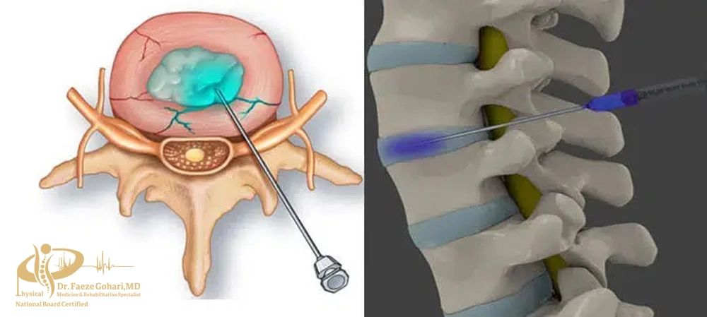 اوزون تراپی دیسک کمر 