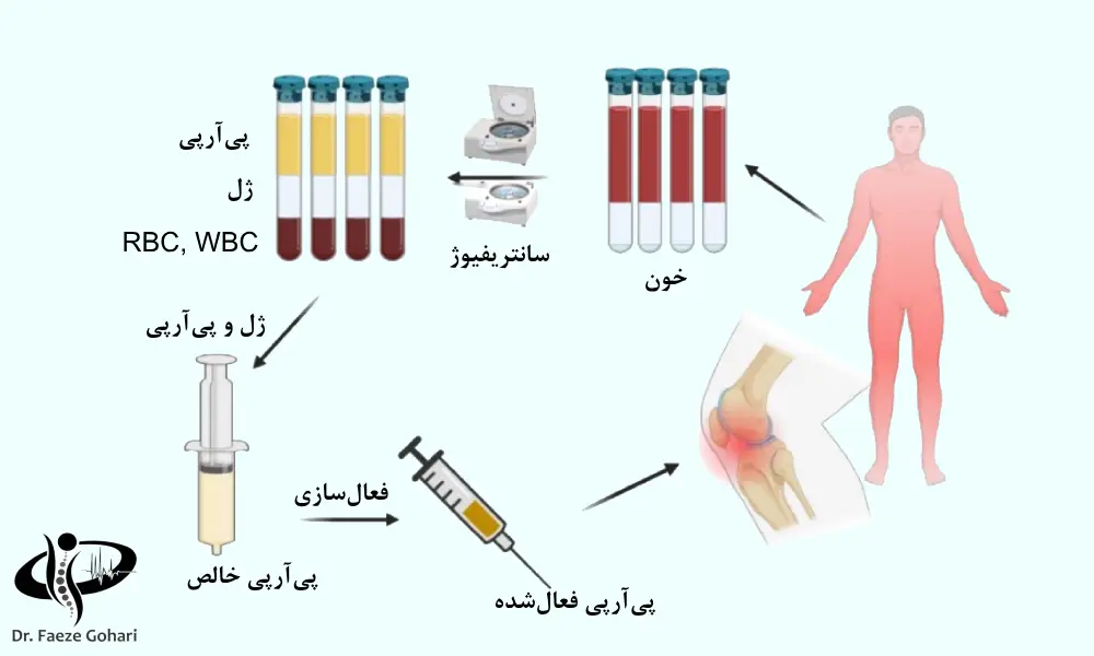 تزریق پی آر پی