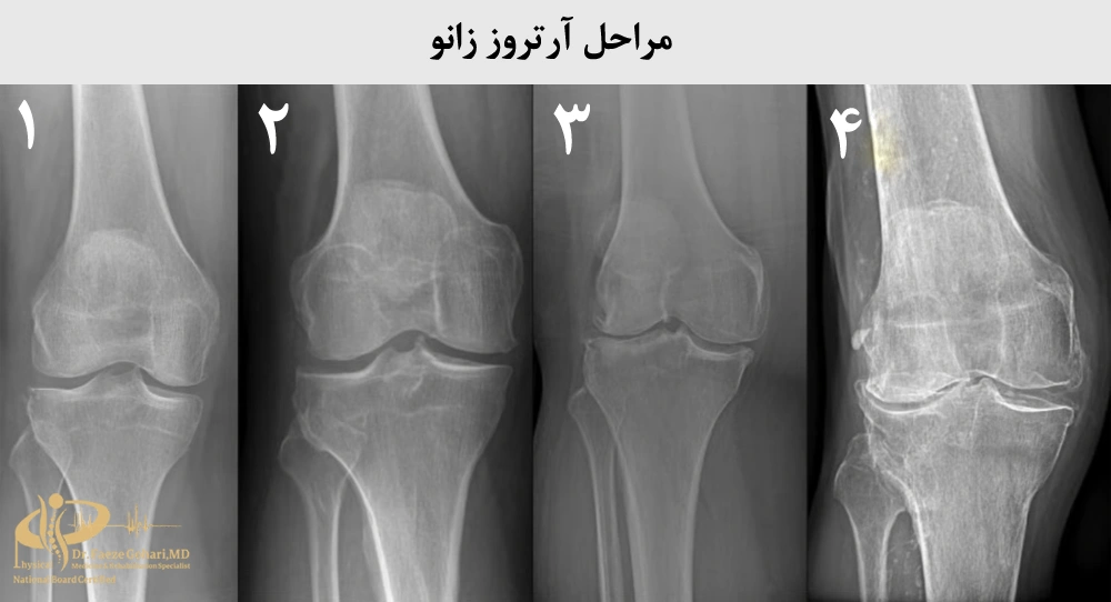 مراحل آرتروز زانو