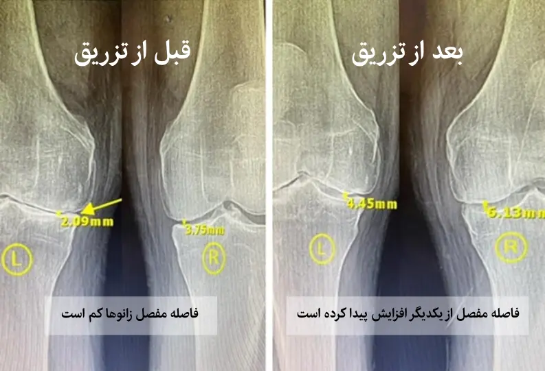 قبل و بعد از تزریق