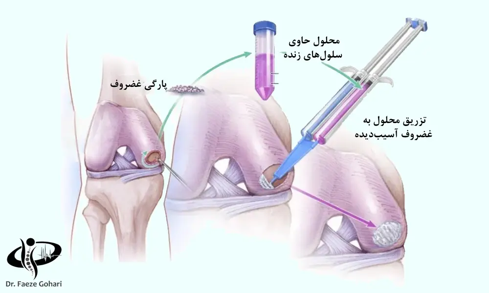تزریق سلولهای بنیادی