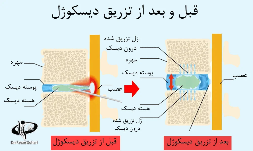 بعد از تزریق دیسکوژل