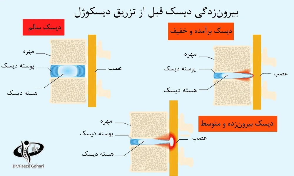 دیسکوژل چگونه بر دیسک کمر یا گردن اثر می‌گذارد؟
